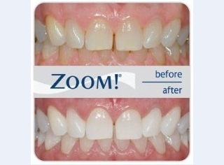 Professionelle Zahnbleichung mit der neuesten 2012 entwickelten  Zoom Lampe. Rufen Sie uns jetzt an!Wenn Sie von uns jetzt einen Termin verlangen ,  dann k�nnen Sie immer und �berall selbstbewusst l�cheln.